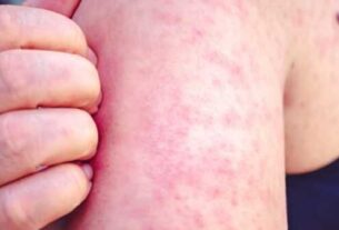 Measles 22