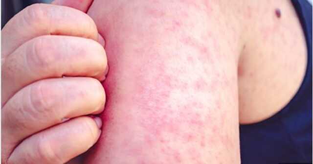 Measles 22