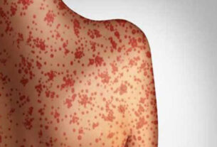 Measles In Mangolia 700x430