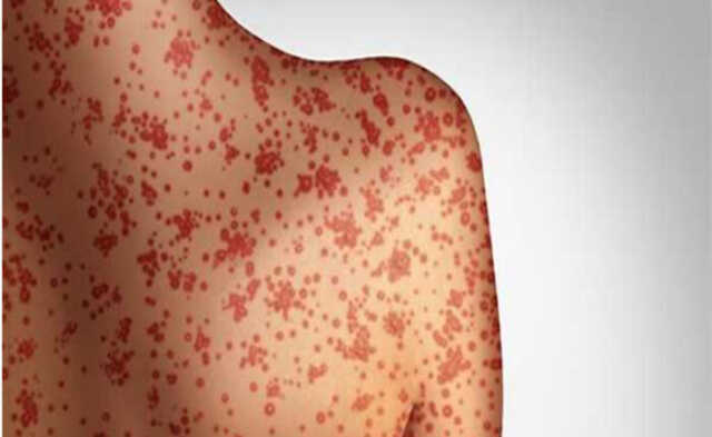 Measles In Mangolia 700x430